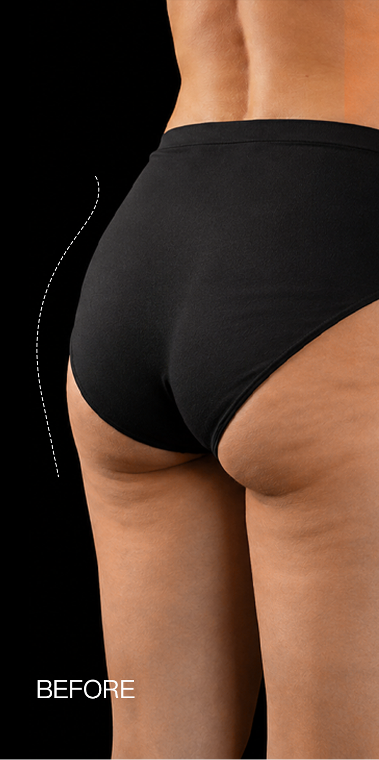 Contouring — before