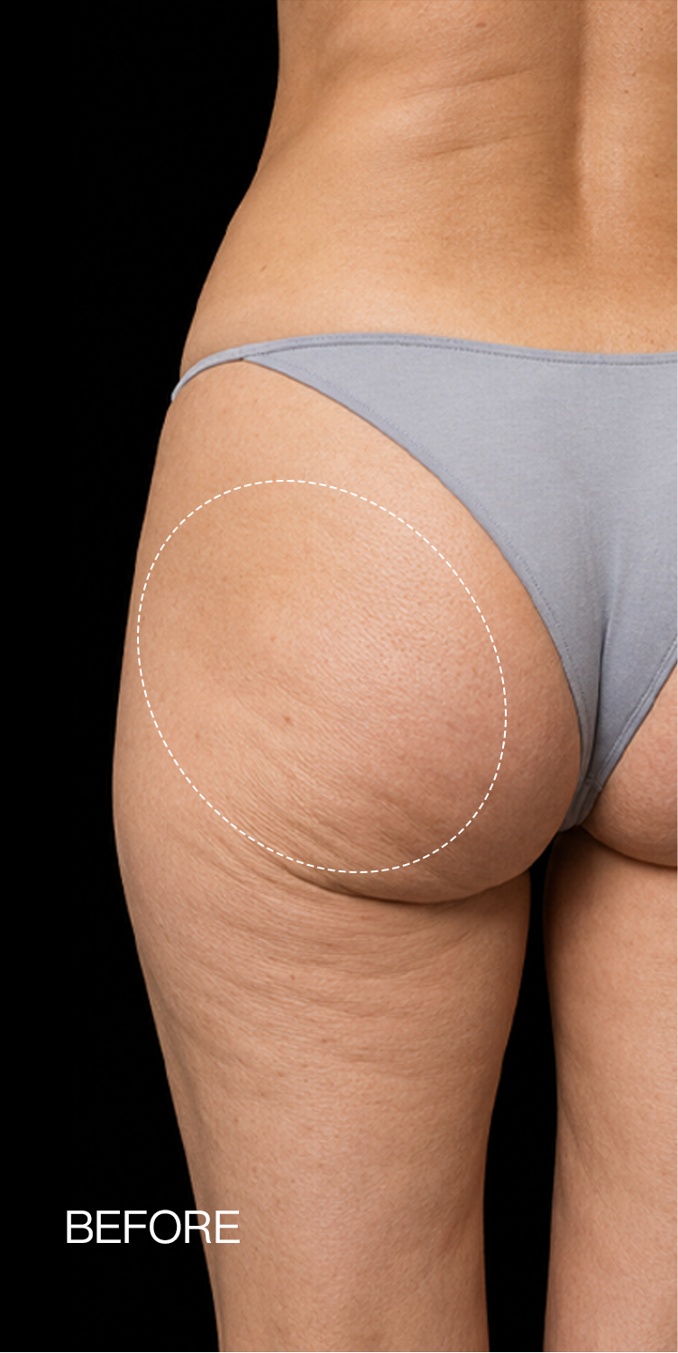 Cellulite — before